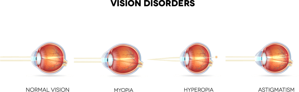 Diagrams of vision disorders
