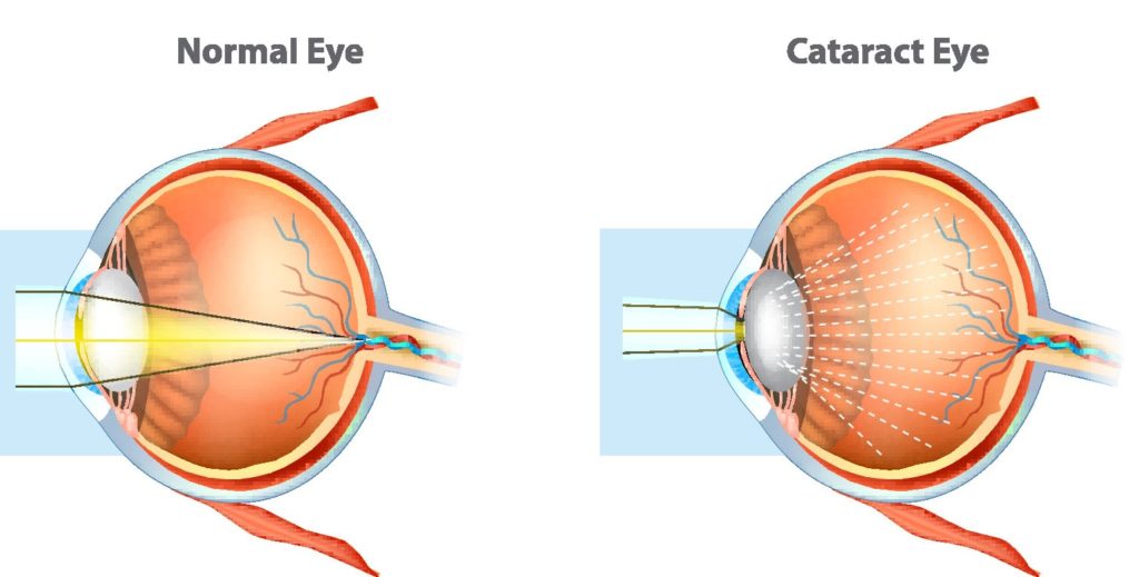 Diagram of a normal eye vs an eye with cataracts