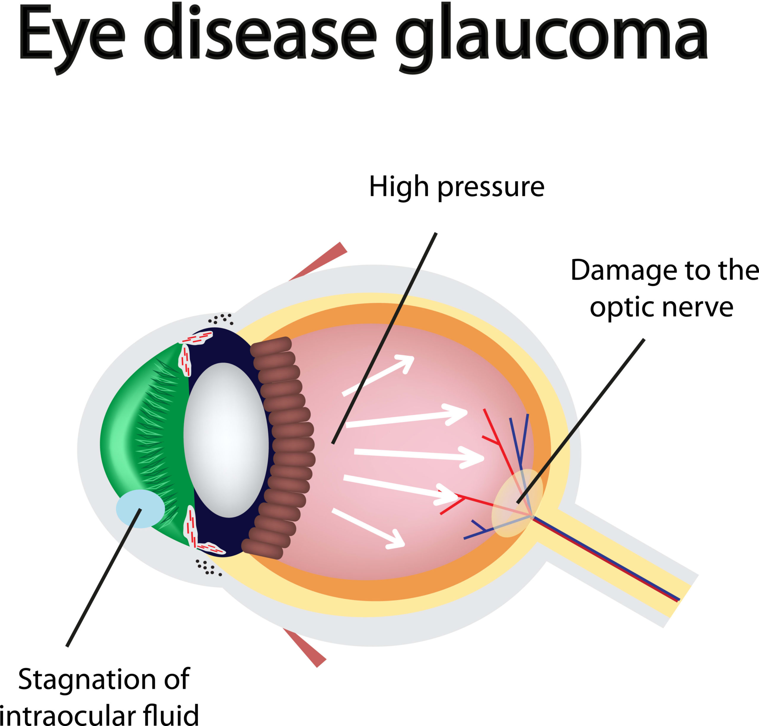 Diagram of an eye with glaucoma