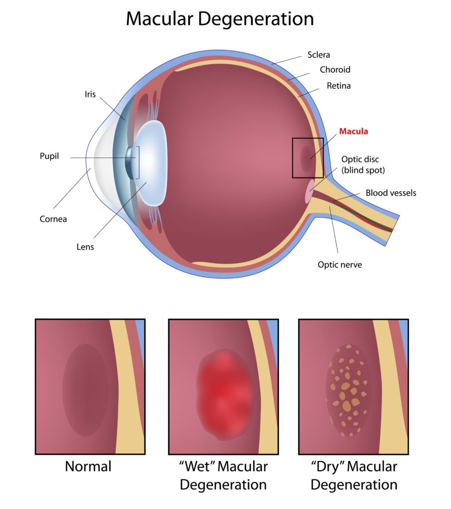 Diagram of an eye with macular degeneration